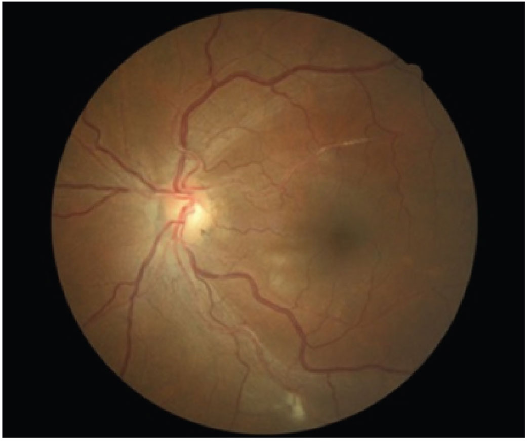 Fig. 4. A patient with grade 3 hypertensive retinopathy.