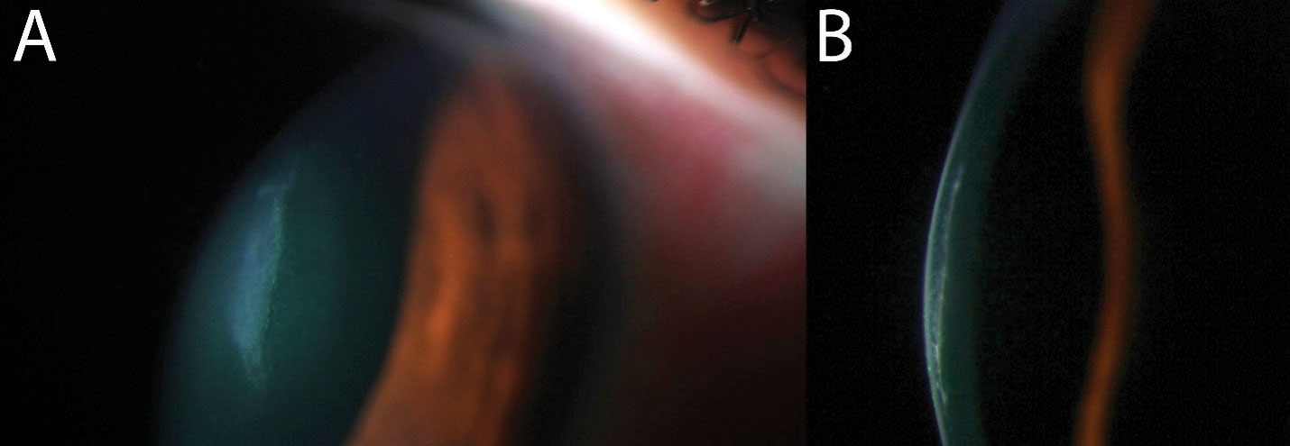A magnified view of the corneal laceration (A) with a dedicated cross-section shows the shelved nature of the laceration, likely allowing the wound to seal on its own (B).