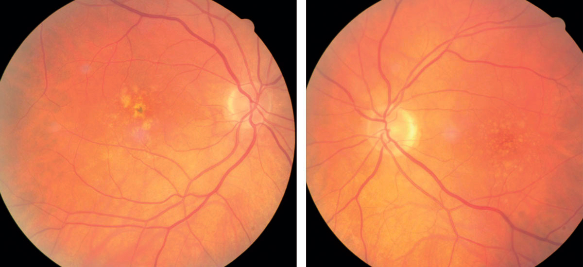 Regular use of lipid-lowering and antidiabetic drugs was associated with a lower prevalence of AMD.