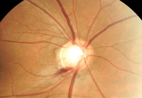 Risk factors for papillary and peripapillary hemorrhage recurrence include axial elongation, mild myopic maculopathy and glaucoma.