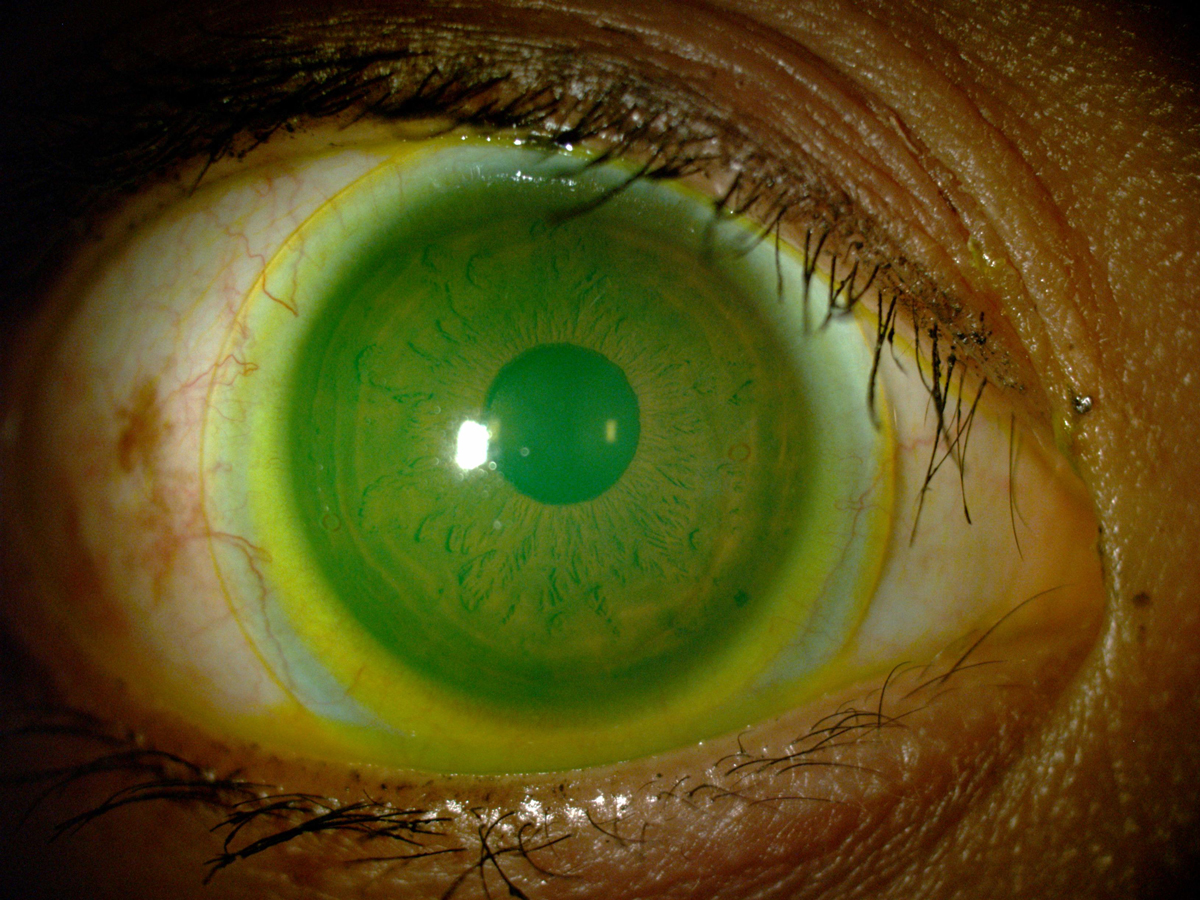 Practitioners now appear to prescribe nonspherical landing zone designs for scleral lenses more frequently than originally thought.