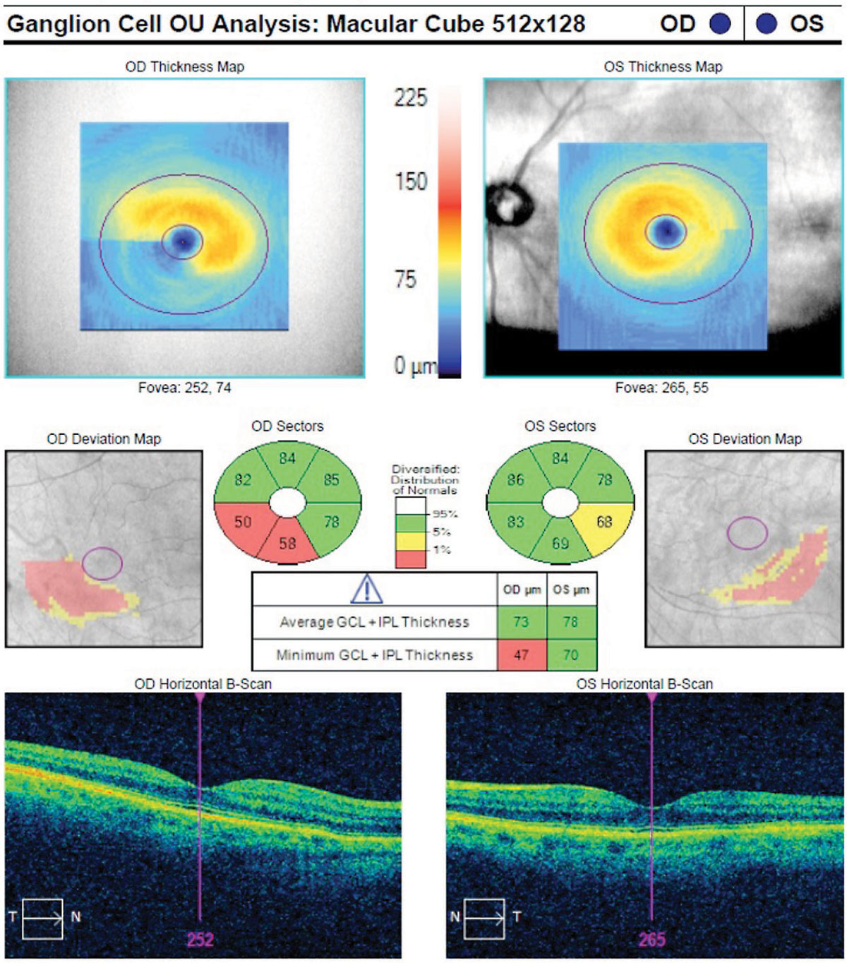 GCIPL thinning shown on macular OCT was found in this study to correlate with increased disease risk in glaucoma suspects.