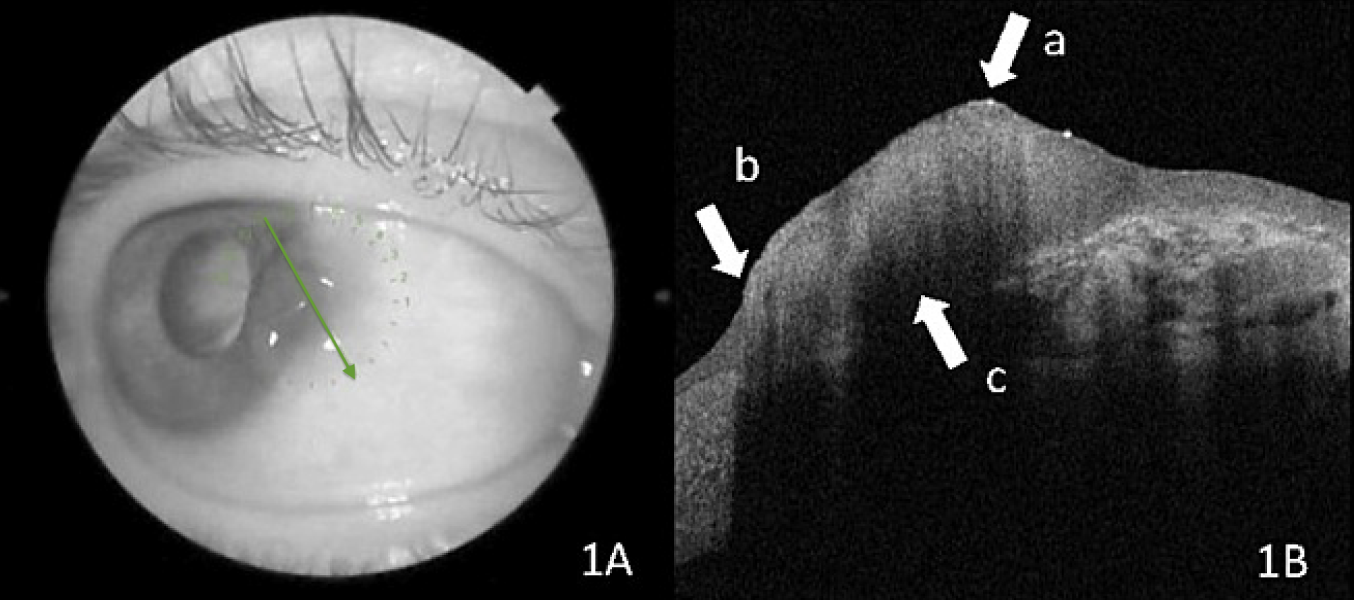 OSSN lesion at the slit lamp and on OCT. The green arrow represents the direction and location of the scans. Arrow A shows a thickened hyperreflective epithelium, arrow B highlights the abrupt transition between abnormal and normal epithelium and arrow C denotes the line of cleavage between the tumor and the surrounding tissue.