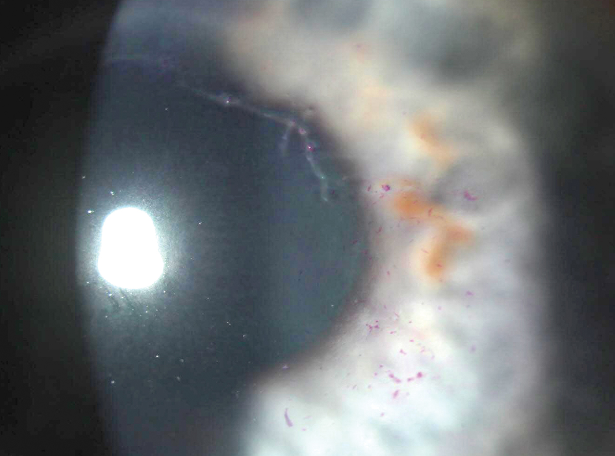 Prior authorization denials and associated delays can impact vision and outcomes. Antivirals used early are important in patients with herpes zoster ophthalmicus.