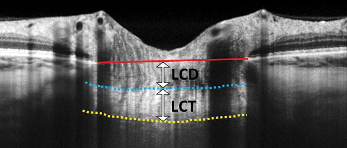 In this EDI-OCT through the optic nerve, the lamina cribrosa thickness (LCT) is measured from the anterior border (blue dashed line) to the posterior border (yellow dashed line). Lamina cribrosa depth (LCD) is measured along a perpendicular line from the anterior border of the lamina to a reference line that connects the edges of Bruch’s membrane (red solid line).