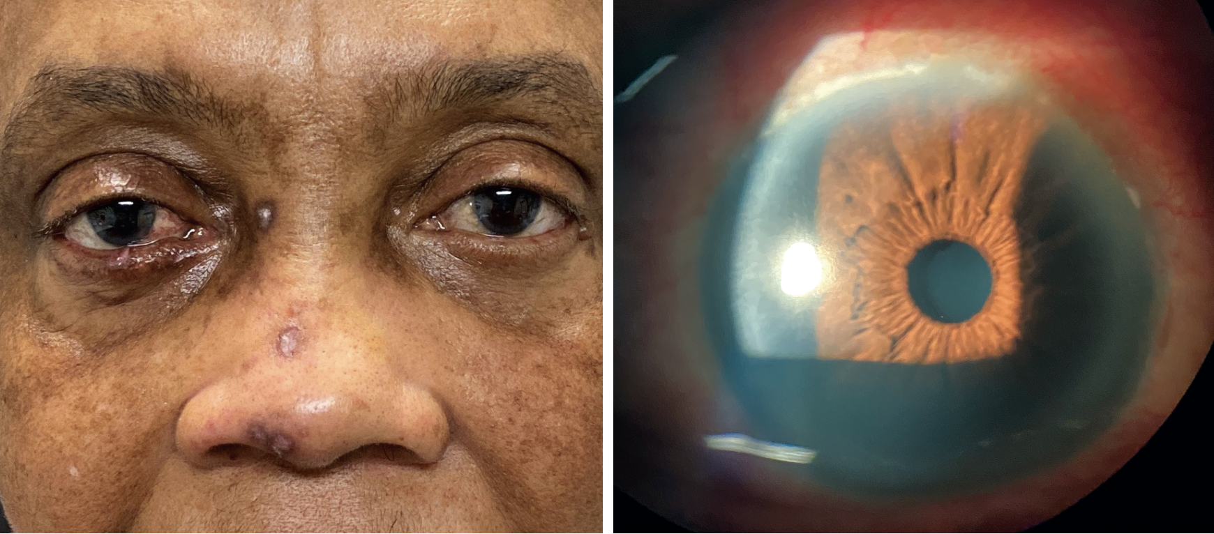 Is there anything in the patient’s ocular or non-ocular presentation that suggests the nature of her condition?