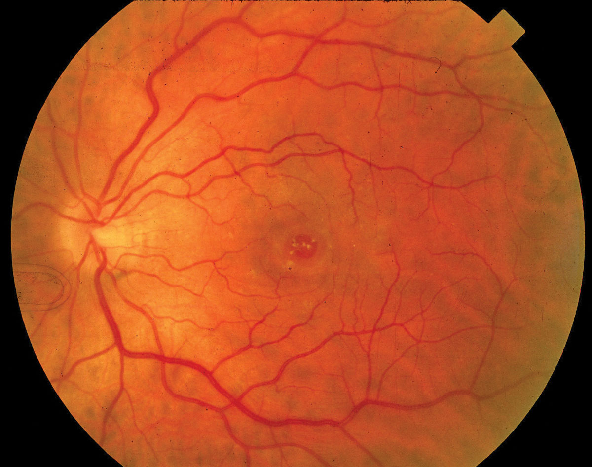 At the onset of a full-thickness macular hole, a foveal inner tear is more likely to occur on the temporal side of the macular hole or the side with the highest posterior vitreous separation height.