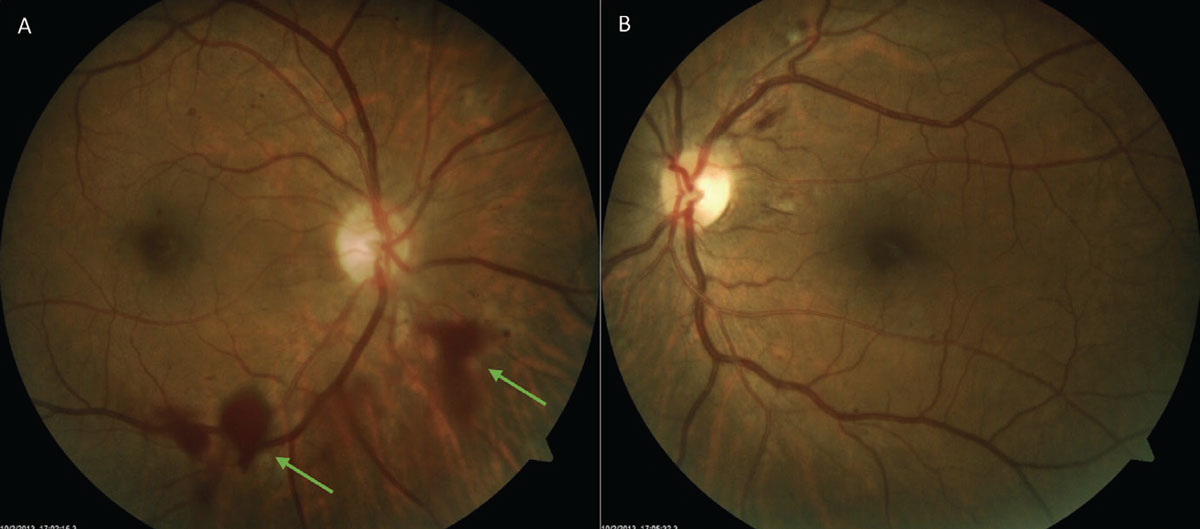 Fig. 4. An inferior localized vitreous hemorrhage (A) due to neovascularization elsewhere from diabetic retinopathy. Note the hazy quality from the hemorrhage when compared with OS (B) with moderate nonproliferative diabetic retinopathy.