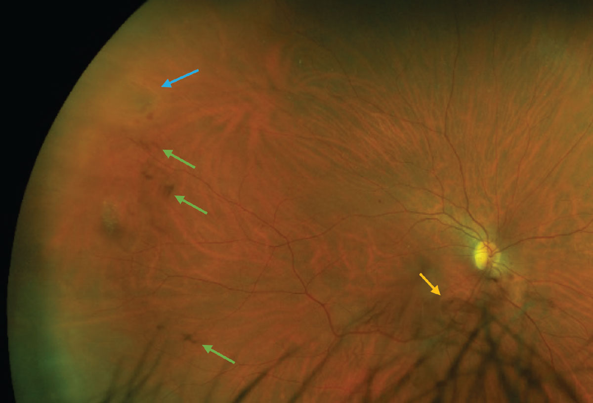 Fig. 6. A patient with an acutely symptomatic PVD and concomitant retinal horseshoe tear (blue arrow) and vitreous hemorrhage (green arrows). The Weiss ring can be seen inferior to the optic nerve head (yellow arrow).