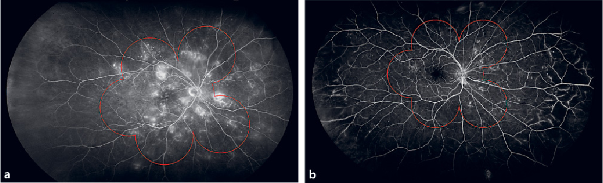 Two comparisons of seven standard field (7SF) fundus imaging (the red overlay) with ultra-wide field fluorescein angiography: (a) right eye of a 48-year-old female patient with moderate DR in which of the pathology is detected with both techniques; (b) right eye of a 64-year-old female patient affected by mild diabetic retinopathy. Microaneurysms are uniformly distributed between 7SF and UWFFA but retinal ischemia and intra-retinal microvascular abnormalities are located outside 7SF boundaries.