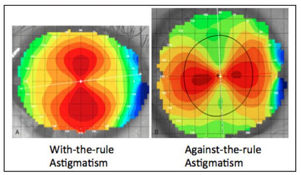 Corneal astigmatism may persist throughout life, but clinicians should be more aware of a possible shift in axis over time from WTR to ATR.