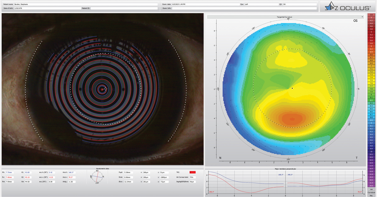 Fig. 2. Corneal topography can be a huge help in a myopia control practice.