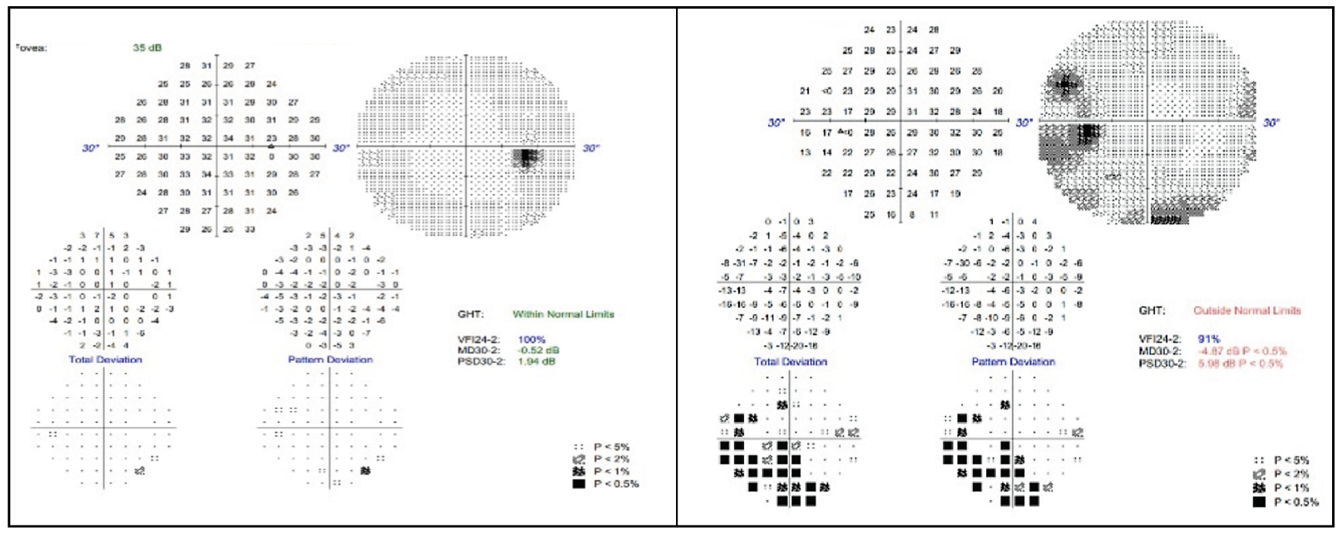 Fig. 1. 30-2 Humphrey visual field of the right eye (left) and left eye (right).