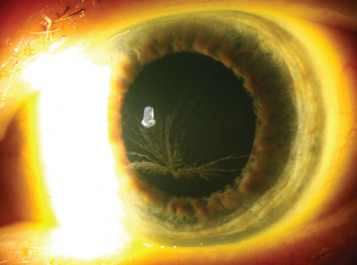 An example of drug-induced corneal verticillata (in a patient on amiodarone therapy).
