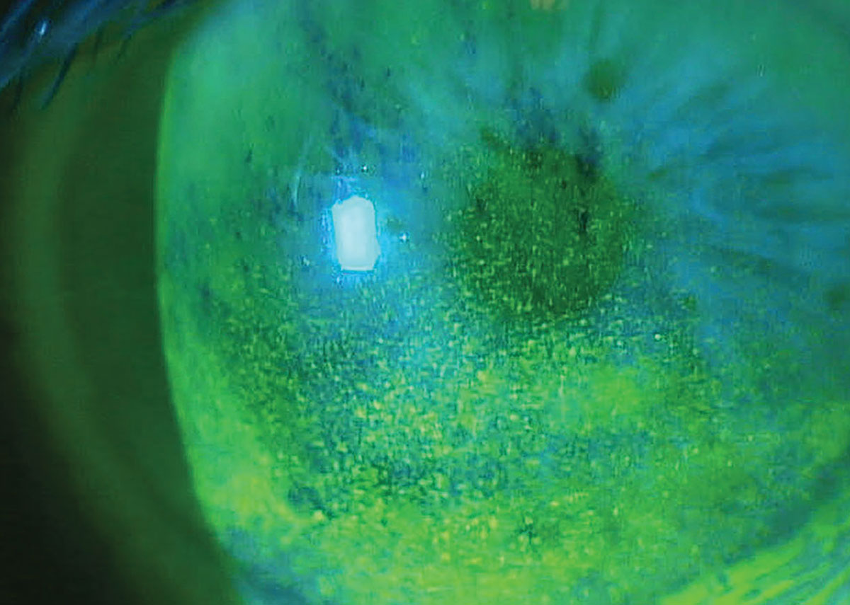 Superficial punctate keratitis in a patient on multiple topical glaucoma medications.