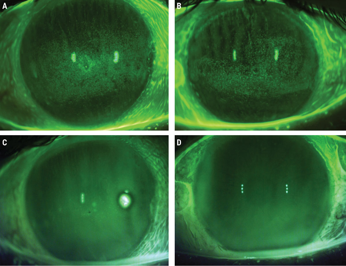 Baseline sodium fluorescein photos prior to ASEDs (A, B) and post-40% ASED use (C, D).