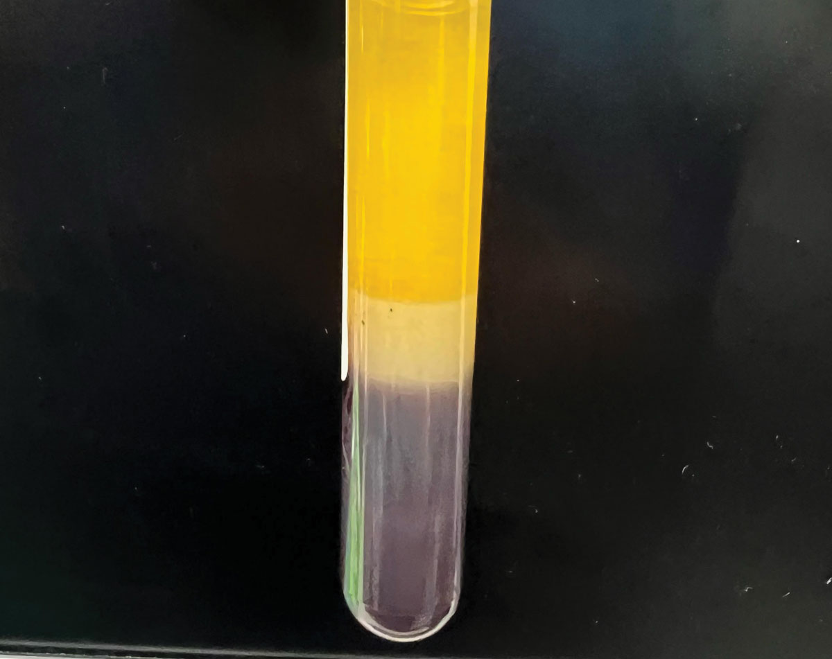 Separation of blood components. Note the serum is bright yellow, clear and free from visible particles and red blood cells. Serum (top), red blood cells (bottom), serum separator (middle).