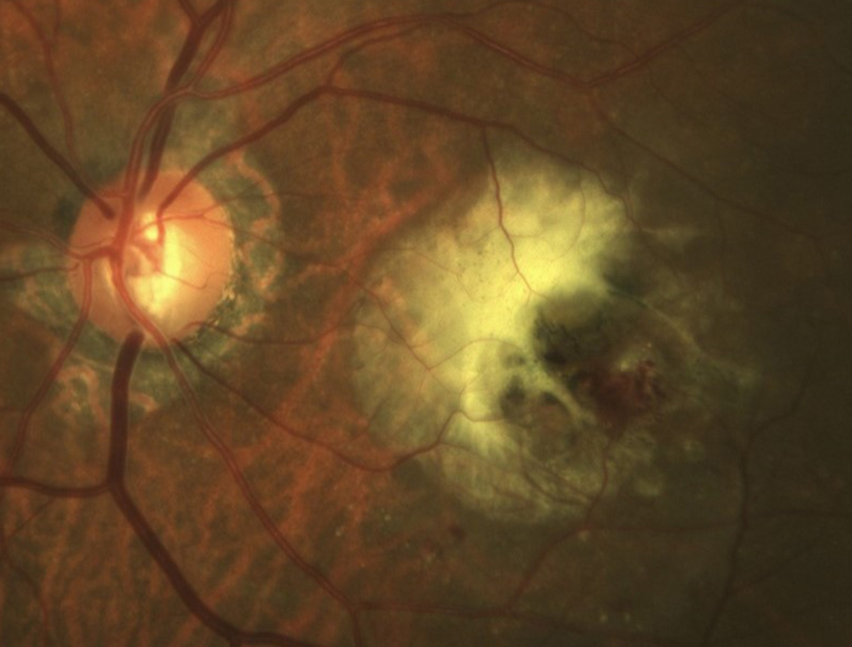 Type 3 macular neovascularization (also known as retinal angiomatous proliferation) involves progression from intraretinal vascularization to subretinal neovascularization and then choroidal neovascularization. Reports show it’s more common in female patients. 