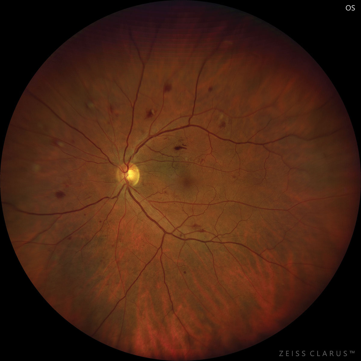 Diabetic retinopathy developed in about 14% of diabetes patients followed for 6.5 years, regardless of whether or not aspirin use was a part of the patient’s daily regimen.