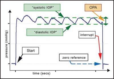 Ocular pulse amplitude tracks changes in IOP that stem from blood pressure dynamics to better characterize intraocular pressure.