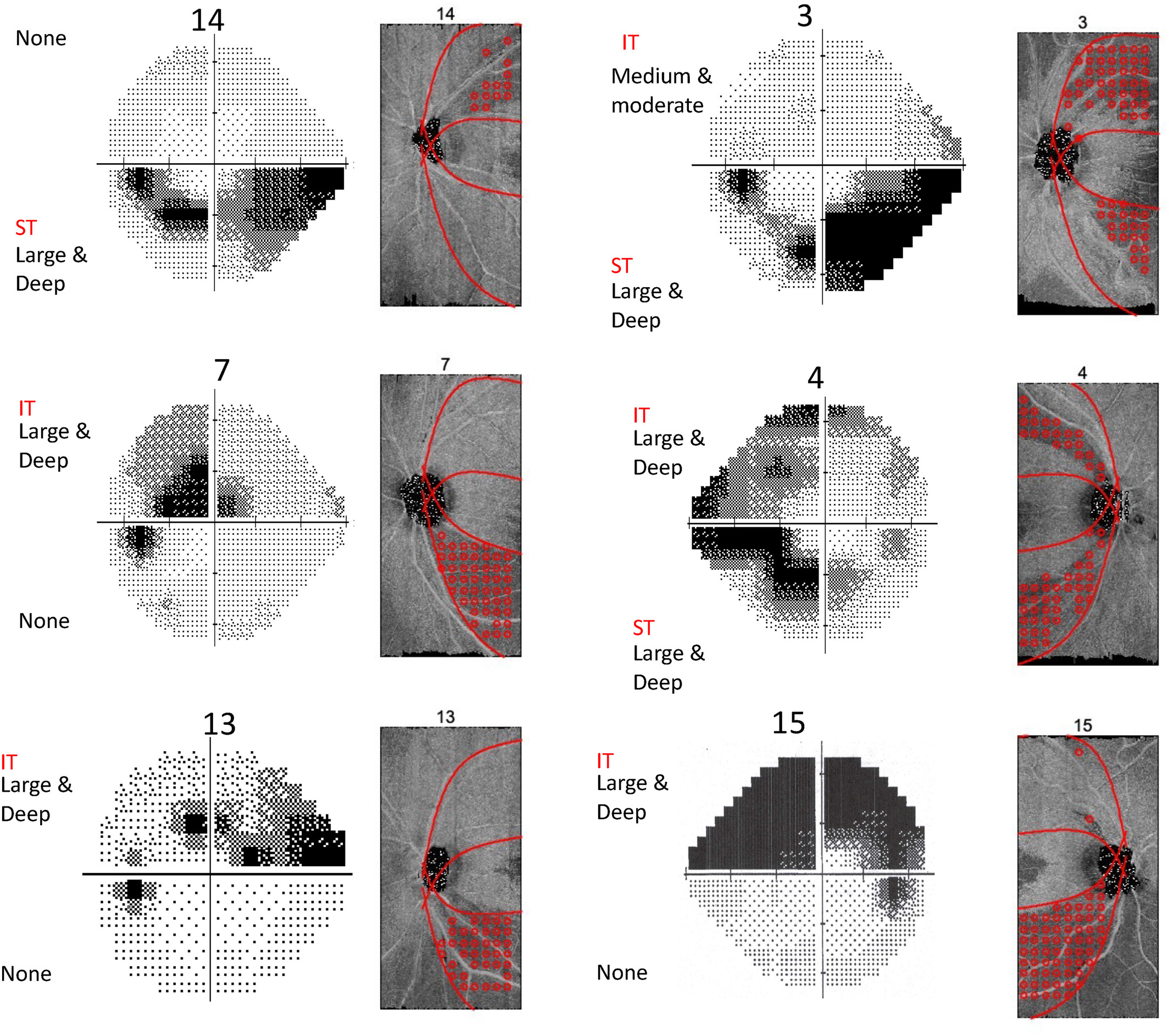 RNFL reflectance images may have potential for use in screening to identify patients most at risk for blindness from undetected glaucoma because of good agreement with perimetry on the location of deep perimetric damage. In this image from the study, anatomical features of RNFL loss (shown in red) correlated with visual field defects.