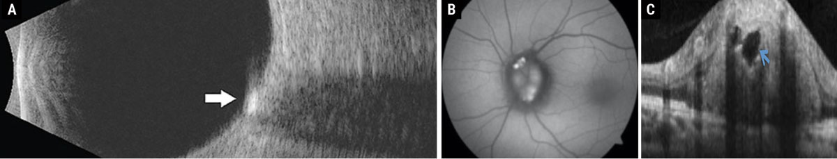 Fig. 1. (a) Disc drusen seen as hyperreflective deposit on B-scan ultrasonography. (b) Disc drusen exhibiting hyperautofluorescence on FAF photography. (c) Disc drusen seen as a signal-poor core with hyperreflective borders on enhanced-depth imaging OCT. 