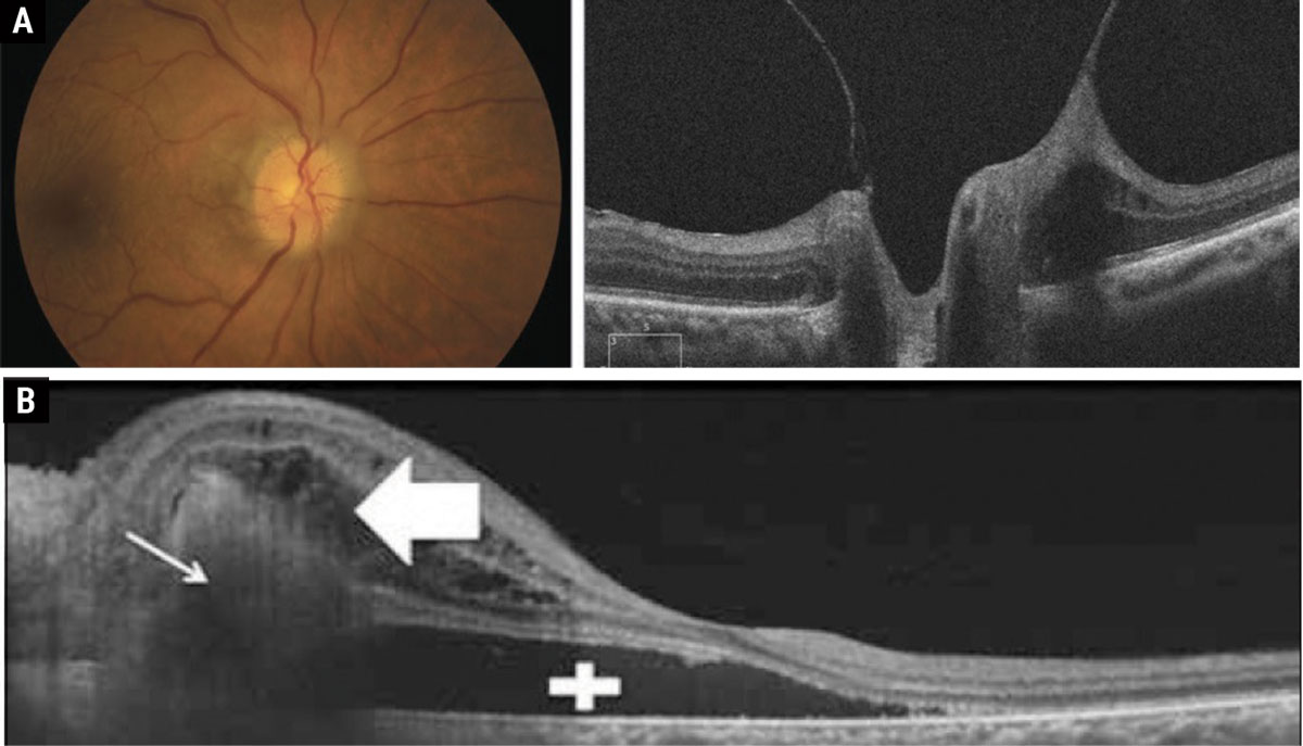 Fig. 2. (a) Vitreopapillary traction causing the appearance of pseudopapilledema. (b) Peripapillary choroidal neovascular membranes with subretinal fluid causing the appearance of elevated disc margins.