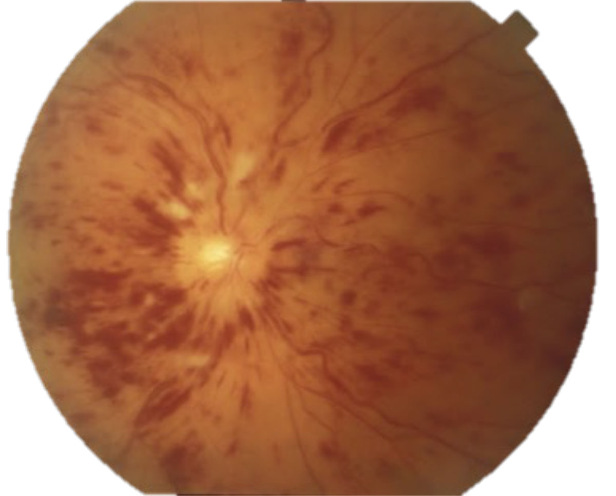 Fig. 5. Central retinal vein occlusion with disc edema.