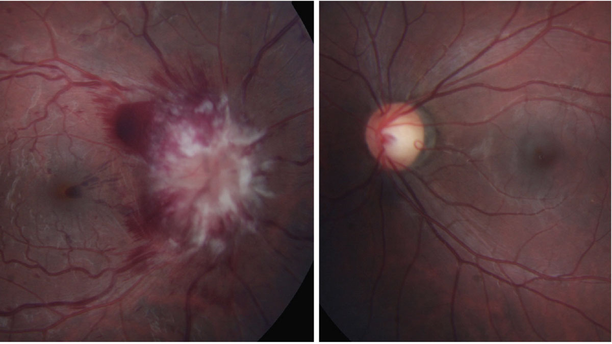 Fig. 8. Leukemic infiltrative optic neuropathy.