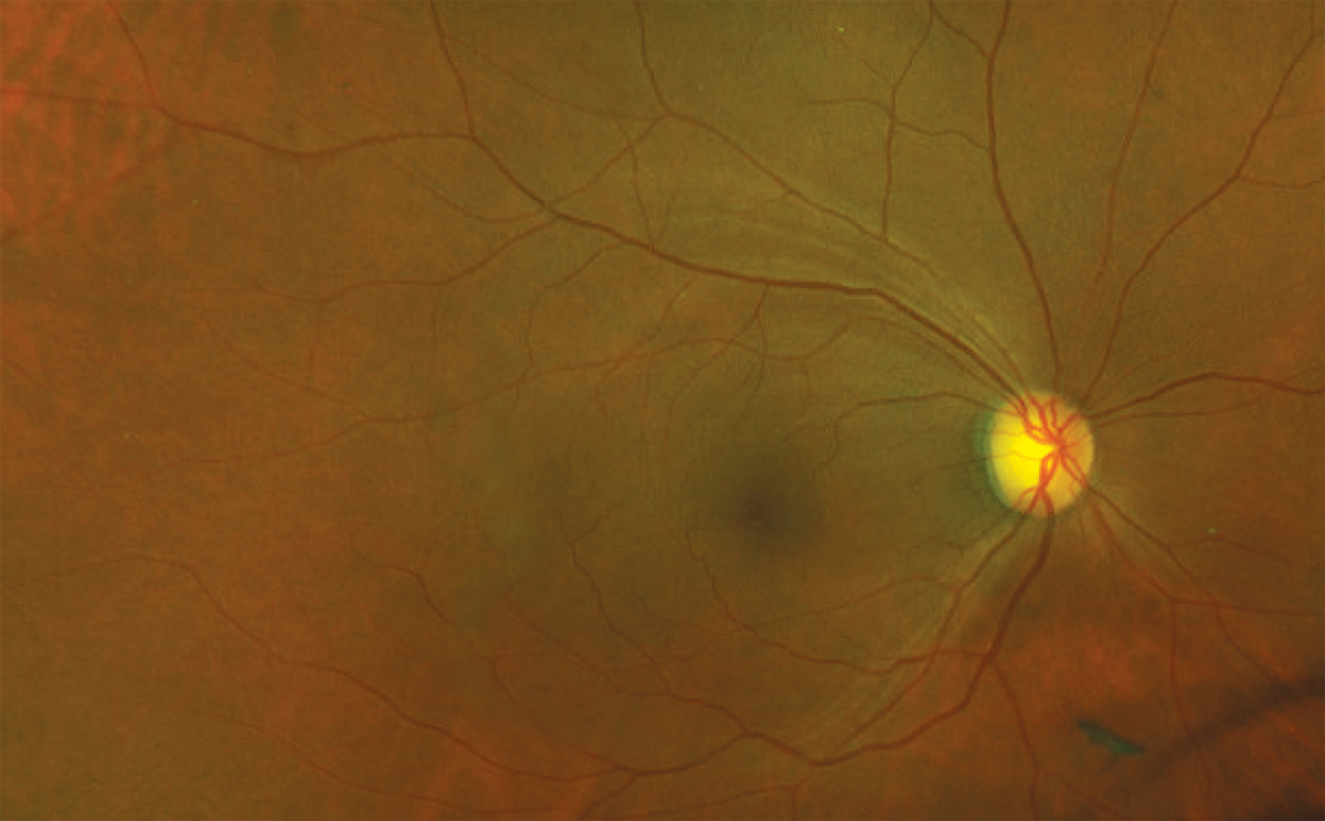 Ultra-widefield image demonstrating superior temporal RNFL defect in the absence of neuroretinal rim notching. A posterior vitreous detachment is visible inferior to the disc.