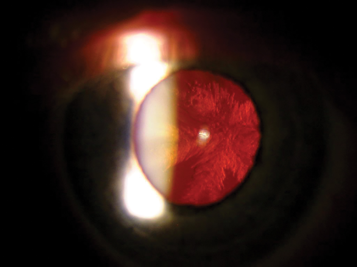 Fig. 5. Posterior subcapsular cataract on retroillumination.