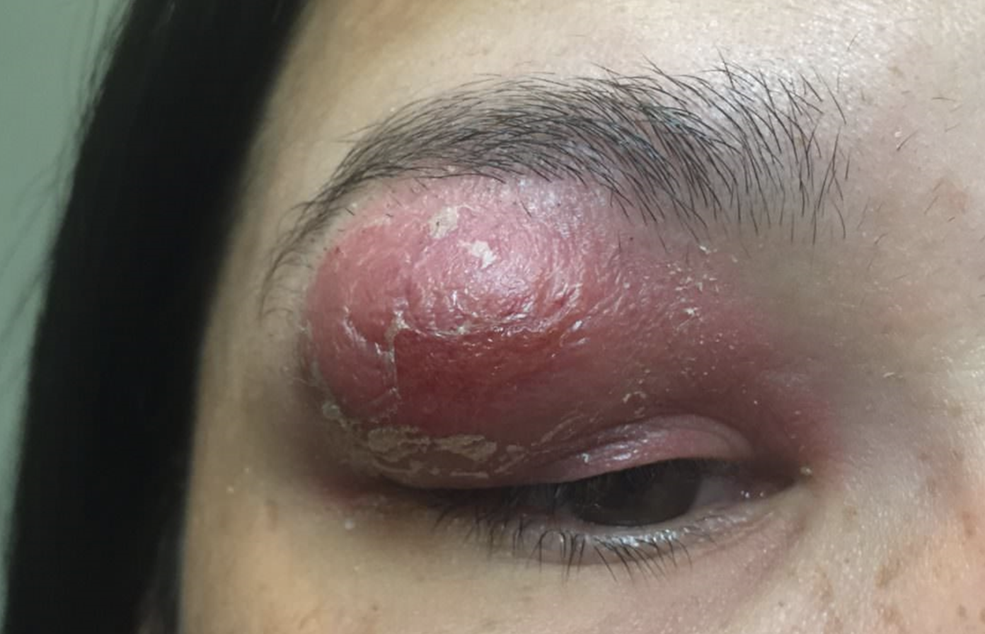 This severe preseptal cellulitis due to MRSA should be treated promptly with oral antibiotics.  
