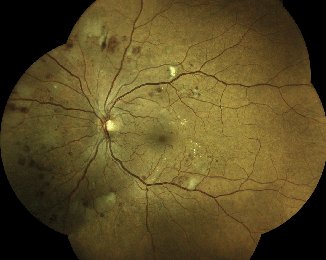 When monitoring patients with diabetic retinopathy, consider the type of medication they’re on and their current retinopathy status to help guide treatment decisions, as this study found that medication class can influence progression to PDR or new-onset DME. 
