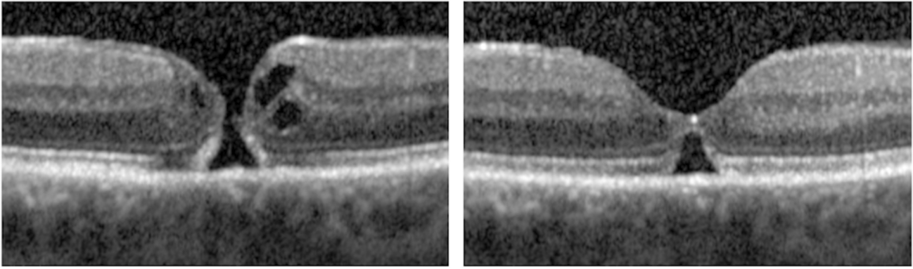 These images from the study show spontaneous closure of an idiopathic full-thickness macular hole with bridging phenomenon in a 57-year-old woman 52 days after diagnosis. Reopening is possible in such cases; therefore, close follow-up is important.