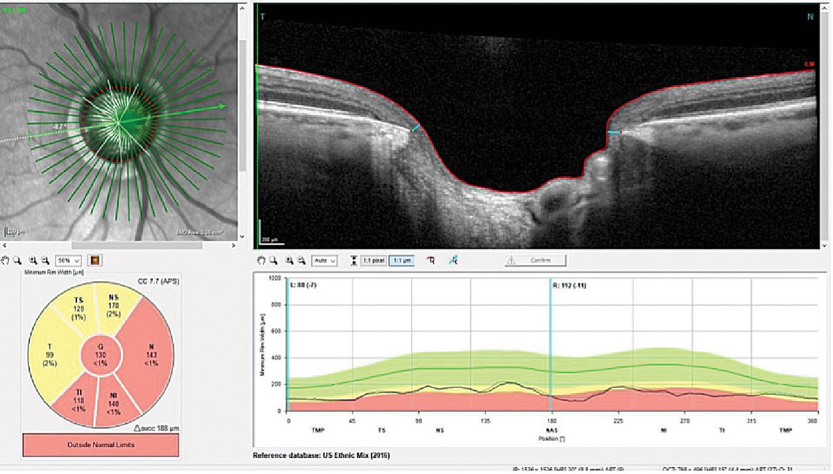 Eyes with optic disc microvasculature dropout had significantly lower optic disc vessel density than those without, while there were no significant differences in parapapillary deep-layer vessel density between the two groups (image is from a different glaucoma patient than those studied).
