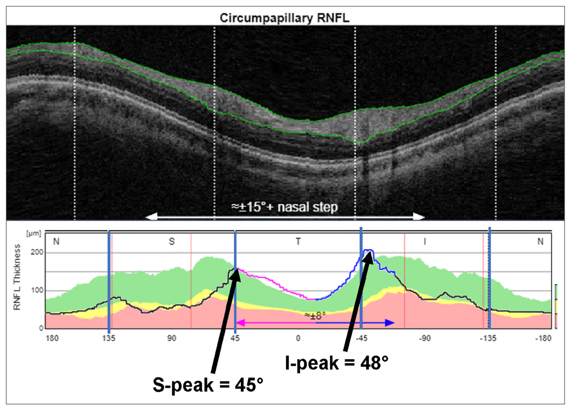 This image from the study shows the location of the superior and inferior peaks of the cpRNFL thickness curve, two of the four parameters associated with abnormal RNFL values in healthy eyes. 