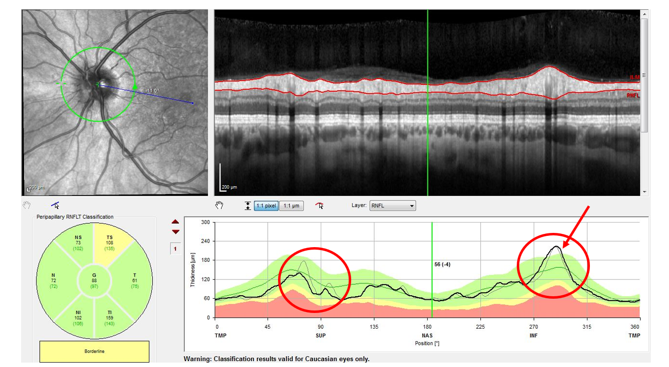 Ocular biomarkers may serve as ideal for testing remyelination efficacy of drugs, as in this MS patient who demonstrates evidence of optic neuritis on OCT.