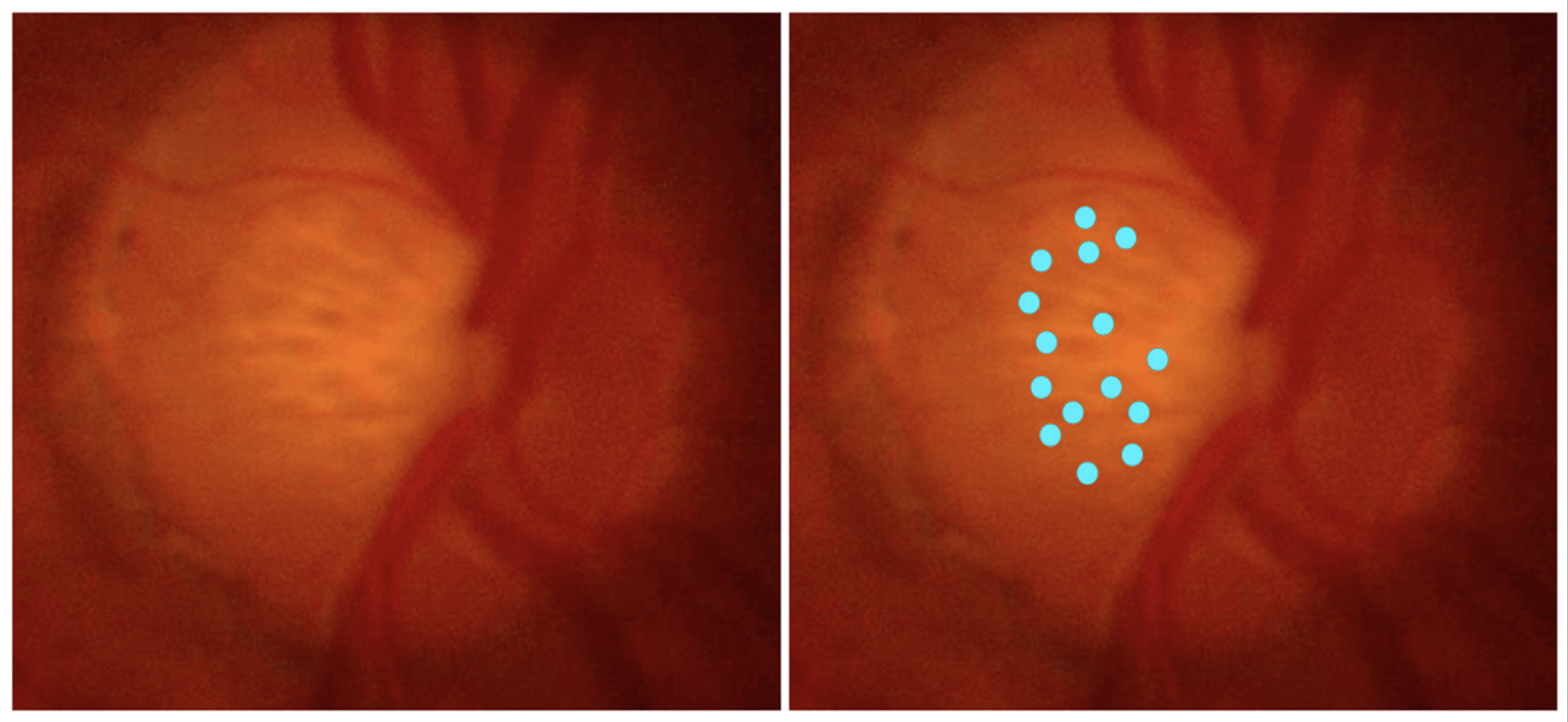 Funduscopic image of optic nerve head with multiple lamina cribrosa pores (left). Blue dots highlighting the location of the pores at the ONH (right). This finding was associated with extremely large CDR, deep optic disc cups, cylindrical and bean pot-shaped cups, the nasalization of central retinal vessels and higher degrees of African ancestry.