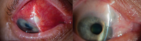 Blebitis (left) and over-filtration of a bleb (right) are among complications associated with more invasive surgeries such as trabeculectomy. MIGS, in contrast, provide better safety profiles, fewer complications and faster recovery times.