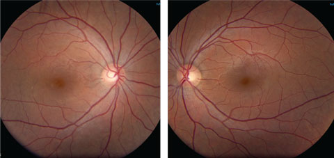 Figs. 1a and 1b. Fundus photos of our 26-year-old female patient’s right and left eyes at clinical presentation.