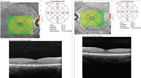 Fig. 2. Can you identify any significant findings in either the patient’s right (at left) or left macula using these SD-OCT images and data? 