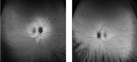 Fig. 5. Note that the right eye (at left) shows patchy hyperautofluorescence around the optic nerve and macula, while the left shows the normal uniformly diffuse autofluorescence in these FAF images.