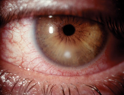 Small noncentral corneal ulcers such as this are typically treated successfully empirically, while larger or more sight-threatening lesions may require culturing.