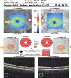 Fig. 2. OCT ganglion cell analysis demonstrating overall ganglion cell/inner plexiform layer thinning compared with normative data.