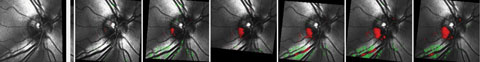 Fig. 2. Progressive structural changes to the inferotemporal neuroretinal rim in the right eye.
