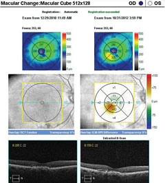 SD-OCT macular change analysis demonstrating the development of DME over a period of less than four months. 