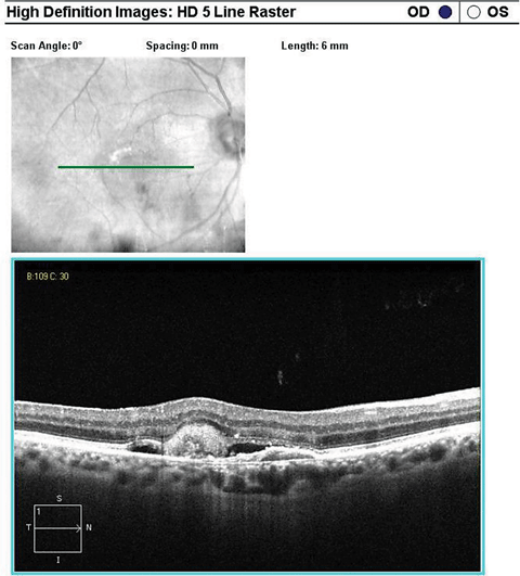 SD-OCT high-definition 5-line raster scan inferior to the fovea over the CNV.