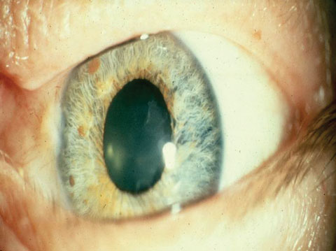 cn iii compression and fixed dilated pupil