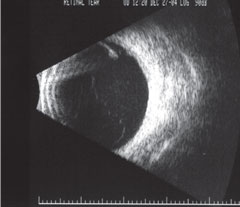 B-scan of a retinal tear on high gain.