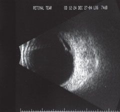  B-scan of a retinal tear on low gain.